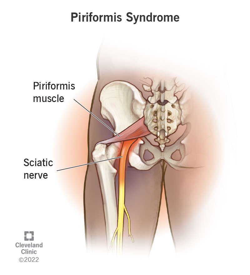 Piriformis-syndrome-1.png|500