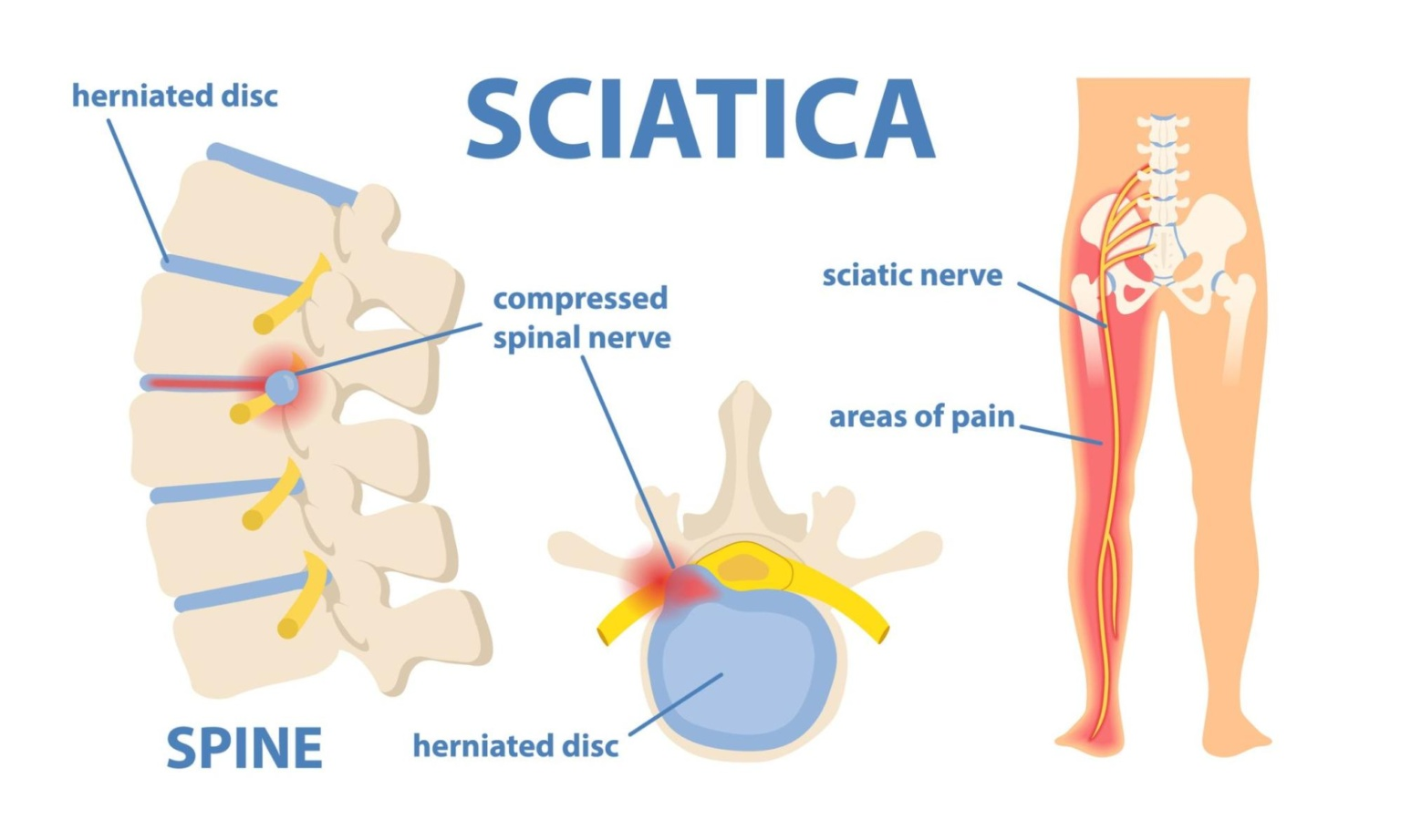 Sciatica-1.png|500